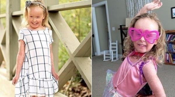 طفلة تغير جلدها بشكل يومي بسبب حالة نادرة