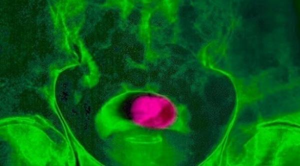 تقنية العلاج الإشعاعي الجديدة عالية السرعة تساعد على علاج سرطان البروستاتا في أقل من أسبوعين