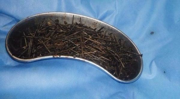 جراحون يخرجون 600 مسمار من معدة رجل