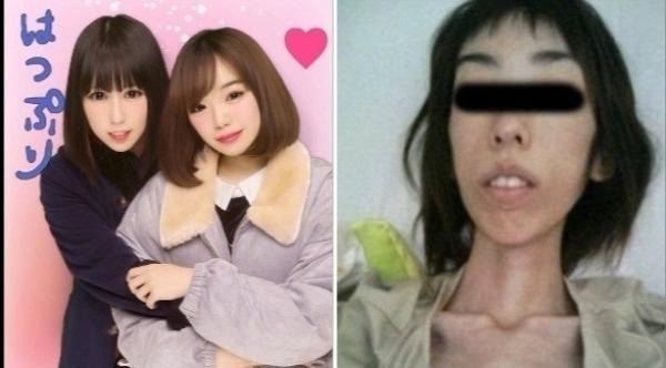 هذه الفتاة تحوّلت إلى "هيكل عظمي"