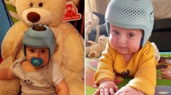 حالة نادرة تفرض على طفل ارتداء خوذة 23 ساعة في اليوم