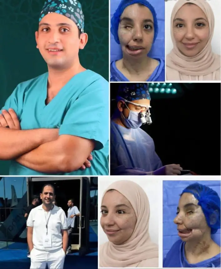 في إنجاز طبي يوصف بـ"المعجزة" :جراح مصري يعيد ملامح وجه فتاة من غزة