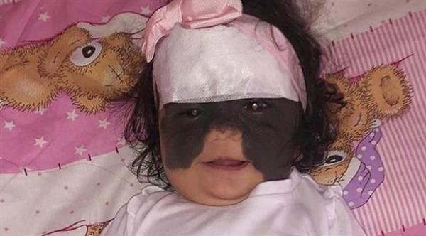 طفلة تولد بقناع شبيه ب"باتمان" على وجهها