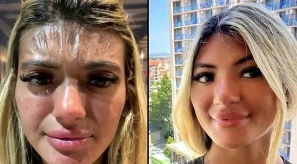 جبين شابة يتحول إلى قطعة بلاستيكية بسبب الشمس