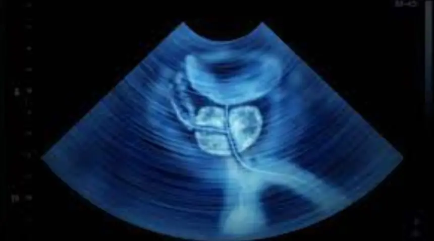 تقنية مبتكرة تقلص أورام سرطان البروستاتا دون جراحة