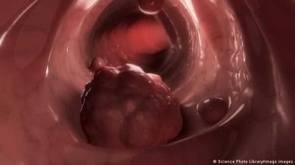 ما هي أسباب ارتفاع إصابة الشباب تحت الثلاثين بسرطان القولون؟
