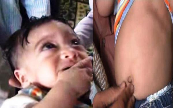 بالفيديو: استخراج جنين في الشهر الثالث من بطن طفل يمني عمره 7 شهور