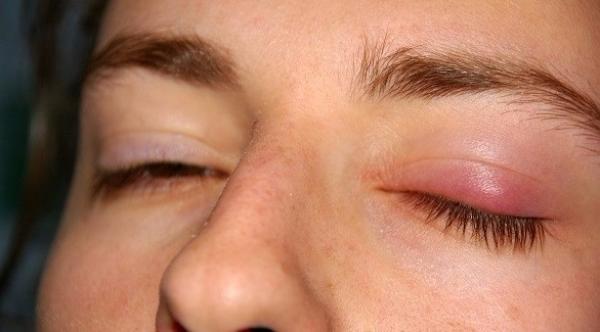 دمل العين...أسبابه وطرق علاجه