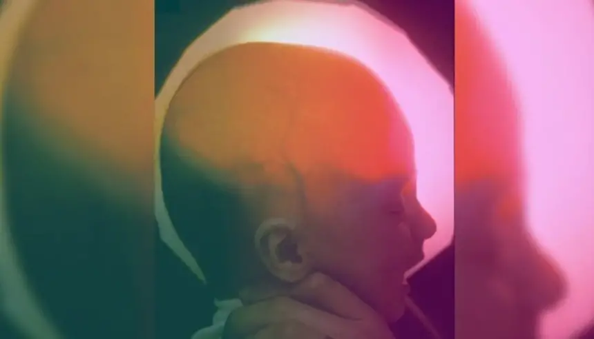 تحدت كل التوقعات... فتاة أمريكية تعيش عشرين عاماً بنصف دماغ