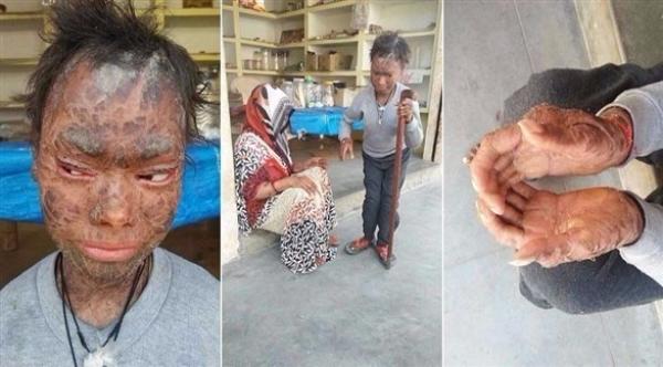 فتاة "أفعى" تبدل جلدها كل 6 أسابيع