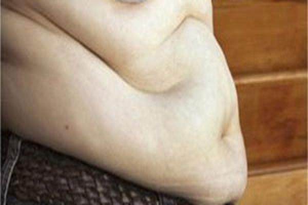 دراسة حديثة : اتخاذ البطن شكل التفاحة يزيد مخاطر الإصابة بأمراض الكلى