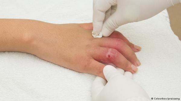 هل يساعد الماء المالح حقا في تعقيم والتئام الجروح؟