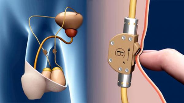 ثورة في طرق منع الحمل...جهاز جديد يمنع الرجل من إنتاج الحيوانات المنوية بضغطة زر