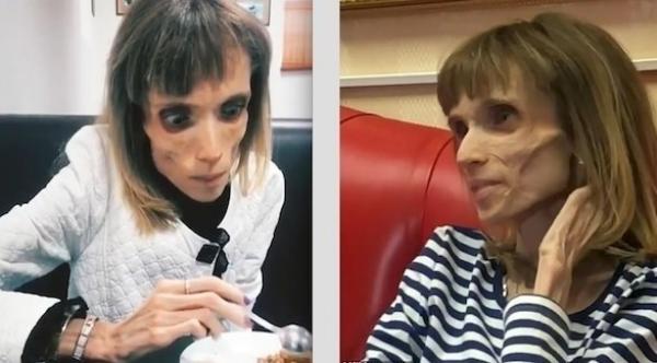 امرأة تزن 17 كغم فقط بسبب حالة صحية نادرة