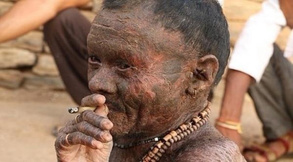 "الرجل الأفعى".. يبدل جلده كل 10 أيام