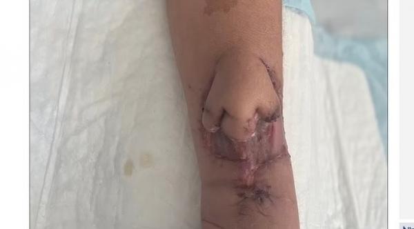 تحصل على أنف جديد بعد أن تمت زراعته على ذراعها