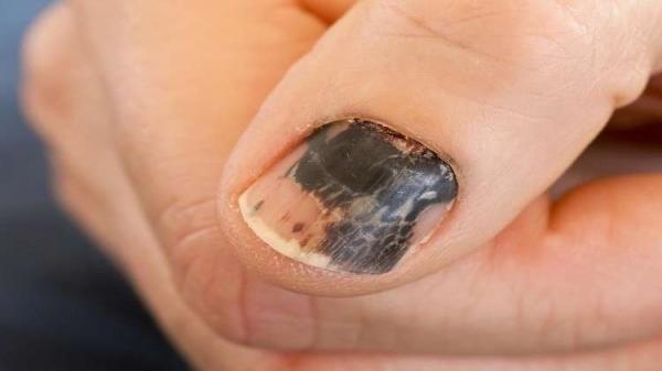 الأظافر تساعد في تشخيص السرطان