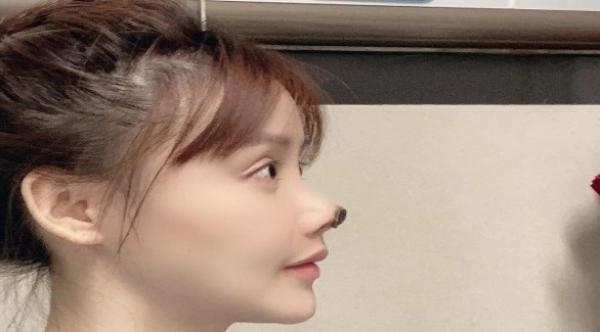 ممثلة صينية حسناء تصاب بتعفن في أنفها بعد الخضوع لعملية تجميل فاشلة