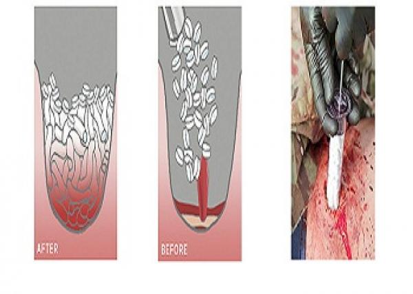 حقنة صغيرة قد تشفي الإصابات بطلقات نارية خلال 15 دقيقة