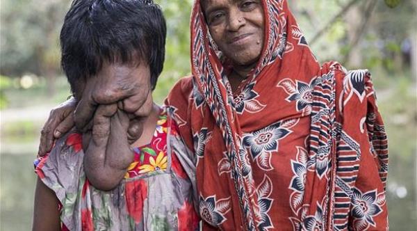 بالصور: فتاة تعيش 21 عاماً بلا وجه