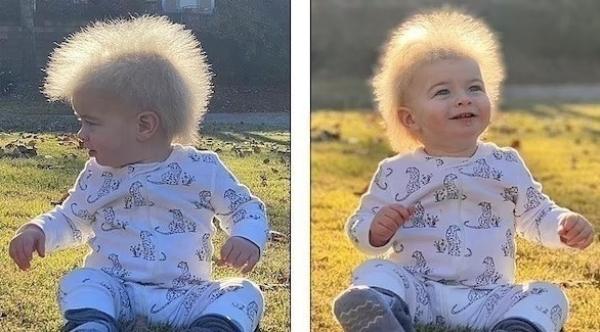 حالة نادرة جداً تجعل شعر طفل ككرة من القش