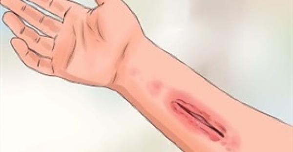 بالفيديو.. 10 وصفات طبيعية لعلاج الجروح في المنزل