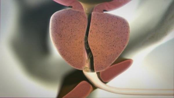 حقائق مهمة عن تضخم البروستاتا وعلاقته بالسرطان