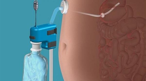 جهاز تخسيس يسحب الطعام مباشرة من المعدة
