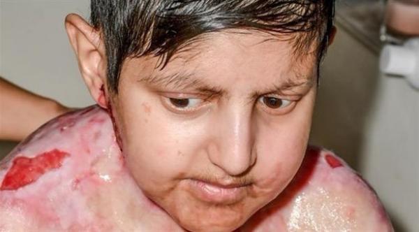 يتقشر جلده بمجرد ملامسته