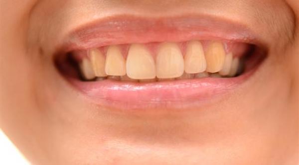 احذر هذه الأخطاء تؤثر على جمال ابتسامتك