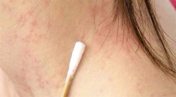 التهاب الجلد العصبي .. المشكلة والحل