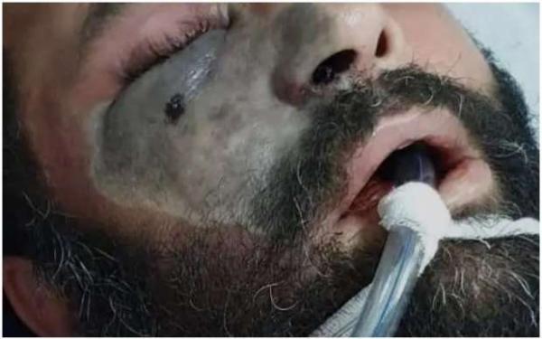 معلومات هامة عن مرض "الفطر الأسود" الذي بدأ يهدد حياة المصابين بفيروس كورونا