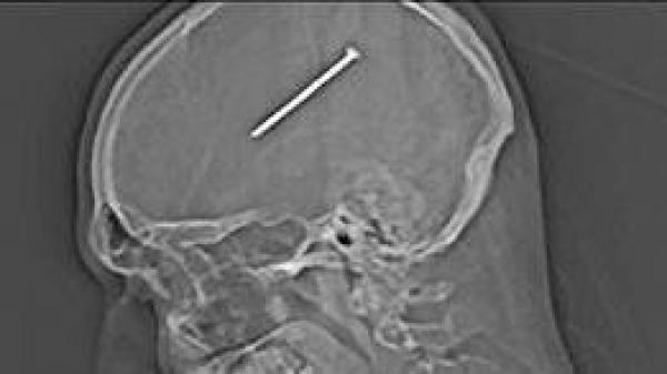 مسمار طوله 8 سم بدماغ رجل، ولم يشعر به