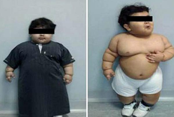 بالصور... أسمن طفل في العالم (عامين) يخضع لجراحة استئصال المعدة