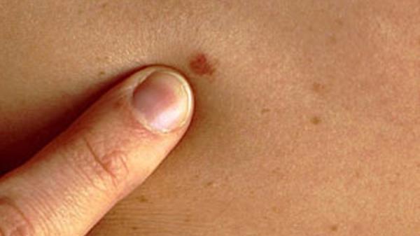 كشف سبب صعوبة علاج سرطان الجلد