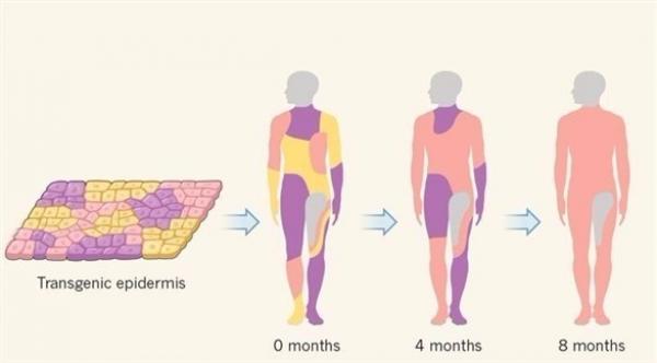 باستخدام الهندسة الوراثية.. أطباء يزرعون جلداً جديداً لإنقاذ حياة طفل
