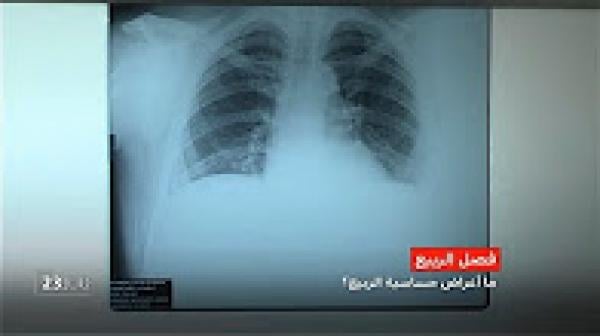 ما أعراض حساسية فصل الربيع وكيف يمكن الوقاية والعلاج؟