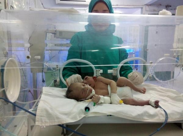 بالفيديو: سيدة مصرية تضع مولودا برأسين وقلبين وثلاثة أذرع