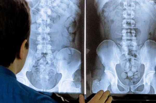 الدار البيضاء .. تفريغ كمية مهمة من الكوكايين من أمعاء نيجيري وسيراليوني