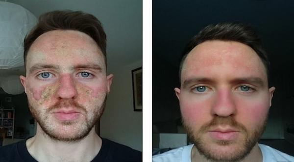 بسبب كريم وصفه طبيب لمعالجة حب الشباب .. رجل يتحول إلى زومبي