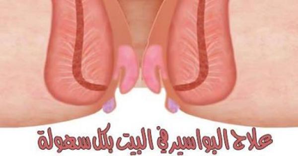 طرق منزلية لعلاج البواسير بكل سهولة