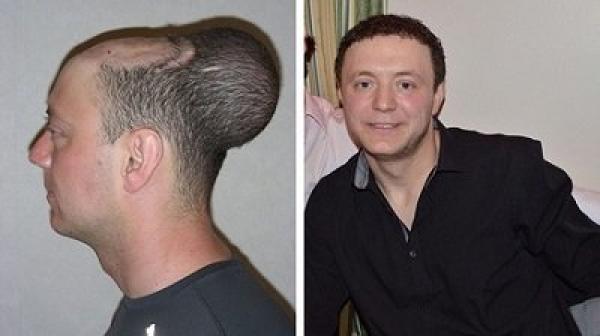 جراحة ناجحة لزرع بالون داخل فروة رأس رجل