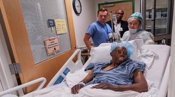 أمريكي من أصل إفريقي يتلقى عملية زرع وجه بعد انتظار سنوات