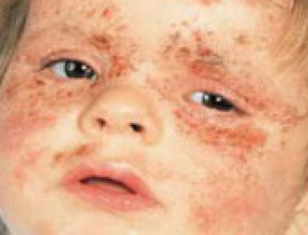 ما هو التهاب الجلد التأتبى فى الأطفال الرضع؟