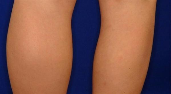 بدانة الأفخاذ تنذر بهذا المرض