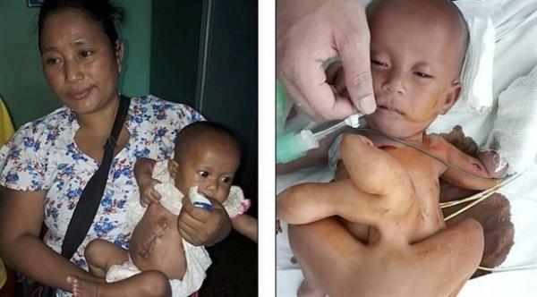 عملية جراحية تنقذ حياة مولودة التصق بها توأم طفيلي