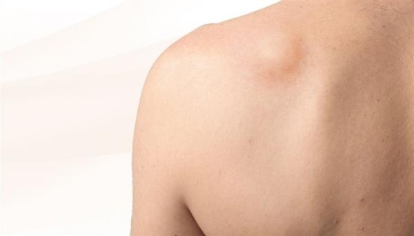 الورم الشحمي على الظهر..هل يدعو للقلق ؟