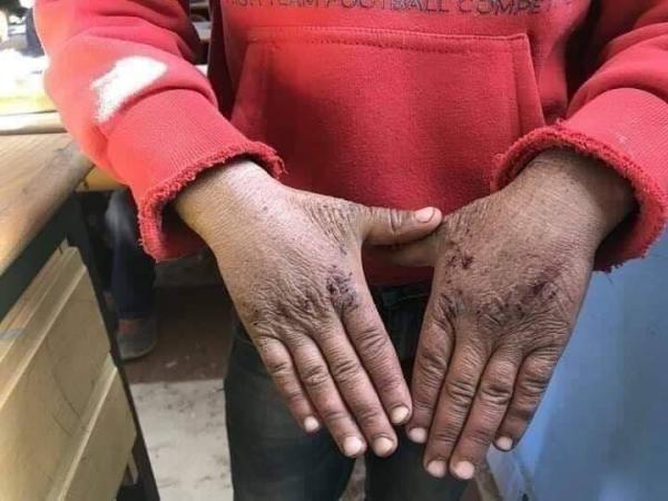 مؤثر بالصورة..أستاذ يكتشف تقطر الدم من يد أحد التلاميذ بسبب موجة البرد