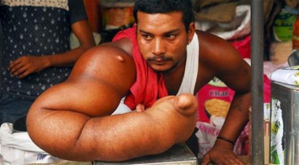 بالصور: هندي وزن ذراعه 20 كيلو ولا تتوقف عن النمو