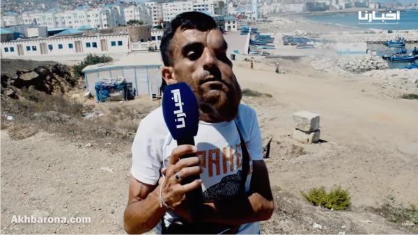 الشاب "علي" بعد عمليتين جراحيتين.. كاين ناس كايخدو تصاور ديالي ويسعاو بهم وأنا مباغيش الفلوس